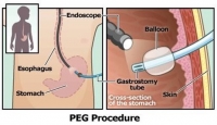 Διαδερμική ενδοσκοπική γαστροστομία (PEG)